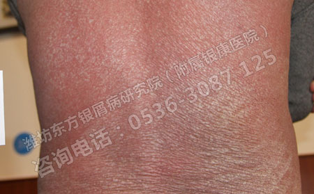 不同程度的銀屑病患者適用什么治療方法