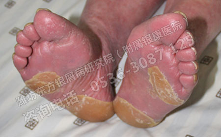 近年銀屑病高發的主要原因是什么