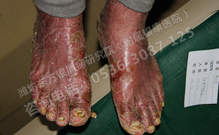 年中銀屑病復發去濰坊哪里治