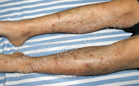 銀屑病復發后應該怎么治療