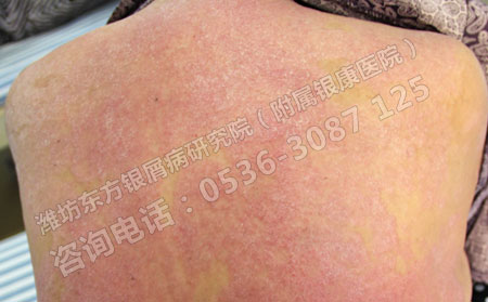 牛皮癬患者應(yīng)該注意哪些因素對(duì)病情的影響