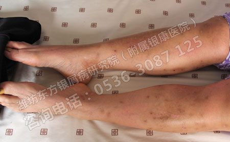 立春后銀屑病復(fù)發(fā)該怎么辦