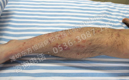 濰坊患者怎么能更快治好銀屑病