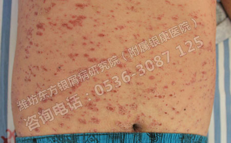 治療牛皮癬病情總是反復發作怎么辦