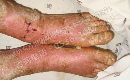 春季患上牛皮癬要怎么治療呢