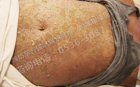 濰坊銀康醫院治牛皮癬優勢