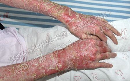 銀屑病的有效護(hù)理措施有哪些?