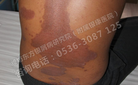 怎樣治療銀屑病能效果更好