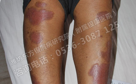 銀屑病有哪些我們不知道的危害