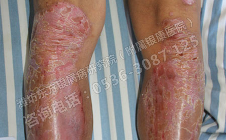 感冒對銀屑病患者的不良影響