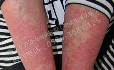 紅皮型牛皮癬的診斷方法有哪些呢