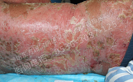 患上膿皰型銀屑病要如何護理