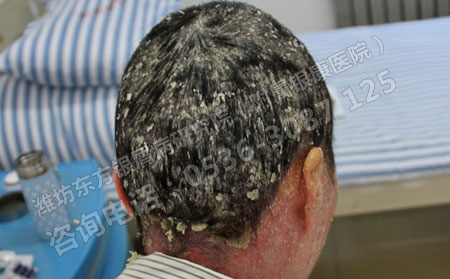 臉上出現銀屑病要注意什么