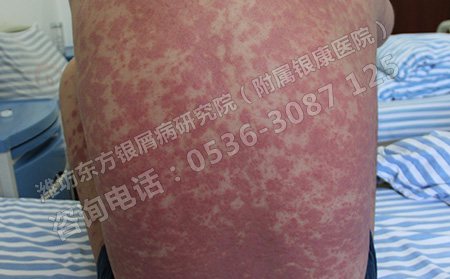 治療膿包型銀屑病有什么好的方法嗎