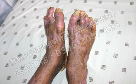 得了關節型銀屑病如何治療好