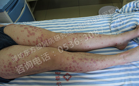 男性銀屑病發生的原因是什么