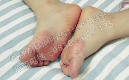 到底哪些人更容易患上銀屑病呢