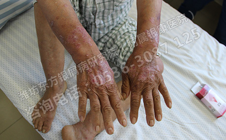 導致銀屑病的誘發因素有哪些