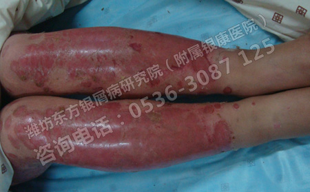 臉部銀屑病要如何進行護理