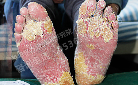 銀屑病采用哪種方法治療比較有效