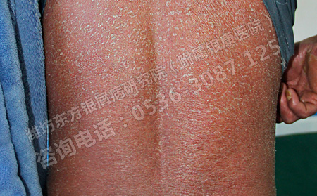 得了背部銀屑病要怎樣進行護理