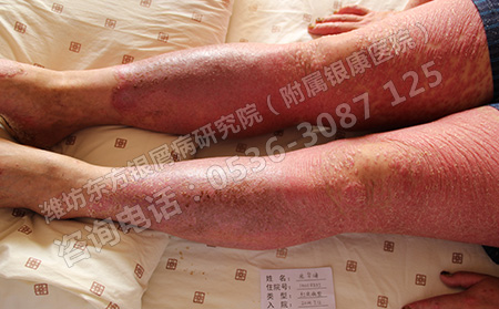 銀屑病要怎樣治療才能可以呢