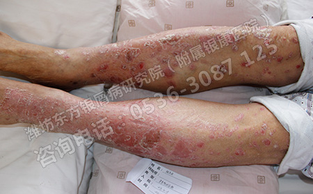 銀屑病常見的危害有哪些