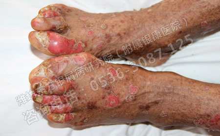 銀屑病如此頑固要怎么治療才能見(jiàn)到效果快