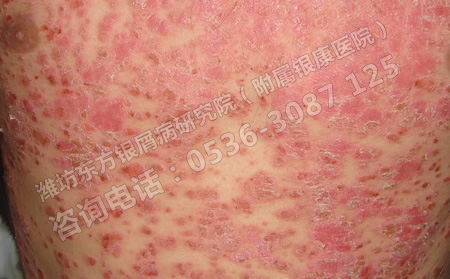 銀屑病患者要如何提高自身抵抗力