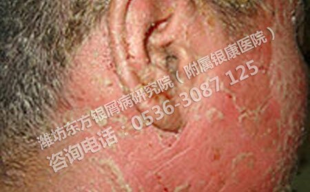 要怎樣護理臉部的銀屑病呢