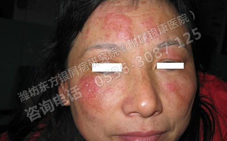 銀屑病能不能有效治好呢