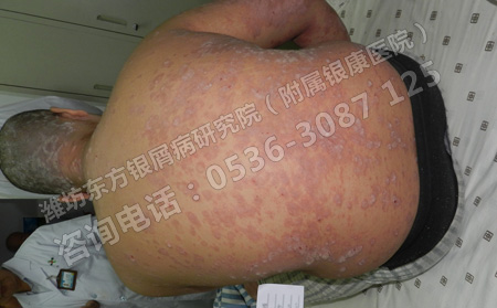 選擇正確的治療方法能夠使銀屑病更快的治好