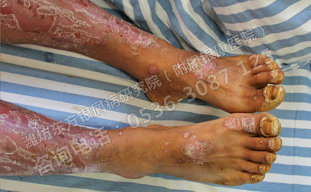 運動有利銀屑病病情恢復但也不能盲目