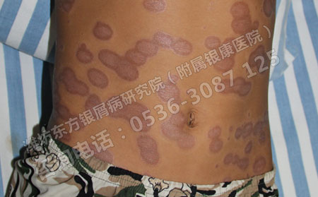 治療兒童銀屑病的重點在哪里