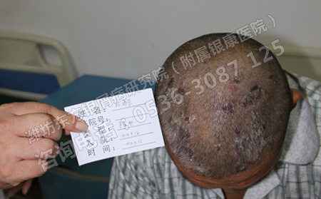 治療銀屑病有哪些行之有效的方法