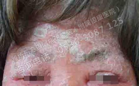 女性銀屑病會影響生育嗎