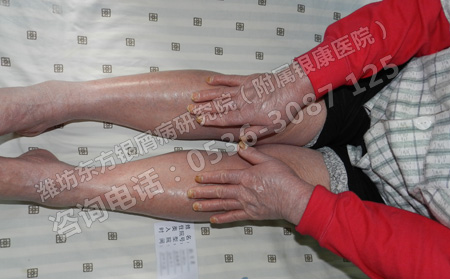 老年人身體虛弱得了銀屑病怎么辦呢