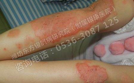 孩子得了銀屑病家長要如何幫助他們護理