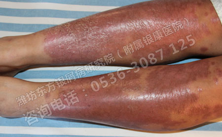 紅皮型牛皮癬有哪些常見的誘因