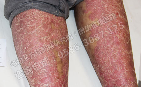 為了減少牛皮癬的傷害老年牛皮癬怎么護理