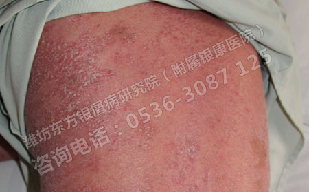 牛皮癬患者應(yīng)該了解的三個(gè)錯(cuò)誤觀點(diǎn)