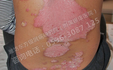 少見的紅皮型牛皮癬發病時的癥狀