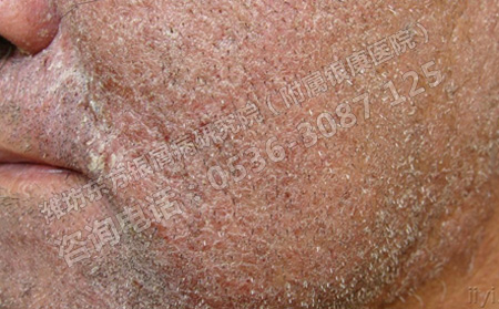 銀屑病為何總是久治不愈呢