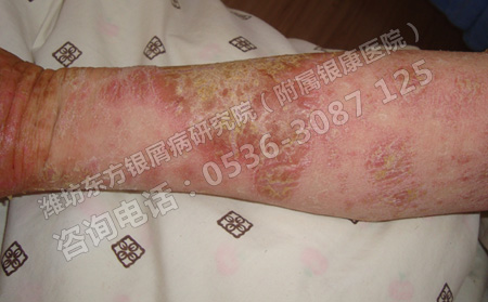 怎樣才能降低銀屑病發生的幾率呢