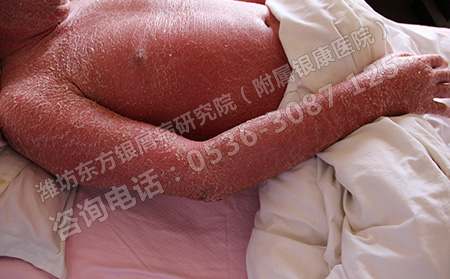 濰坊采用什么方法治療牛皮癬能夠使其更快的恢復呢