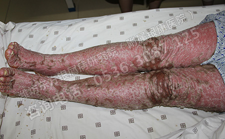 到底哪種方法治療牛皮癬能有效恢復(fù)呢