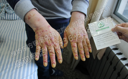 牛皮癬應(yīng)該怎么護(hù)理