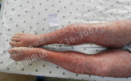 牛皮癬有什么癥狀