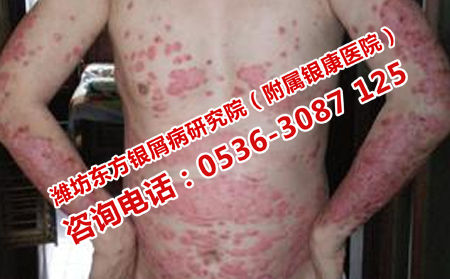 牛皮癬怎樣治治療效果果可以呢