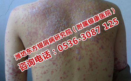 怎樣治療尋常型銀屑病